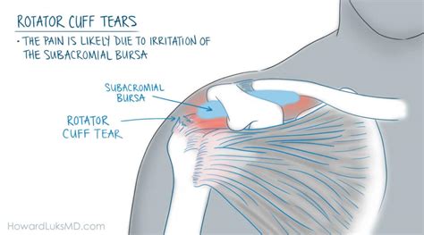 Rotator Cuff Injury Including Rotator Cuff Tear, Rotator Cuff Bursitis, Rotator Cuff Symptoms ...