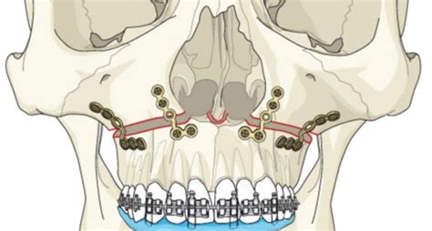 Le Fort Osteotomies | Le Fort Osteotomy I, II, III | Cost | Risks ...