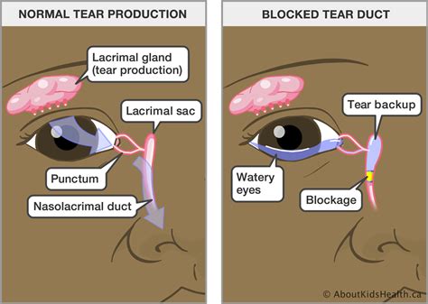 Blocked Tear Duct in babies: Meaning, Symptoms and treatment