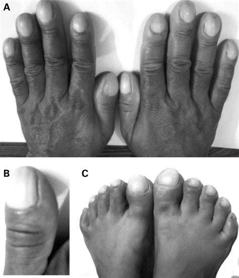 How Does Nail Clubbing Occur@^*