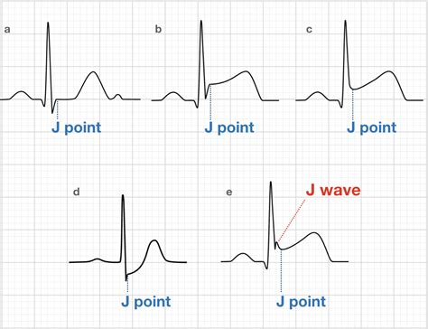 J point ECG Interval • LITFL • ECG Library Basics