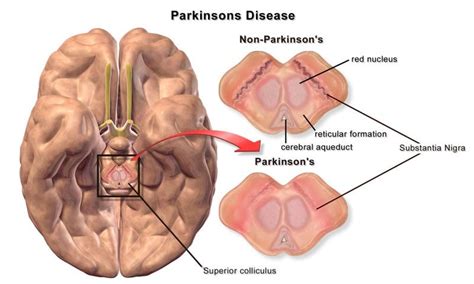 parkinsons disease brain differences – Neuroscience News