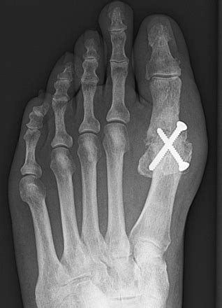 Hallux Rigidus London | Big Toe Arthritis| Hertfordshire UK