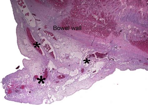 The histology of the adherent small mesenteric rim with dilated blood ...