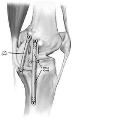 MCL Reconstruction Surgery | Medial Collateral Ligament Repair