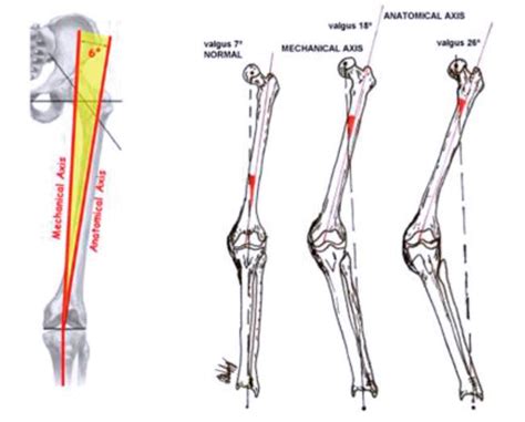 Valgus Deformity Correction in Total Knee Replacement: An Overview | IntechOpen