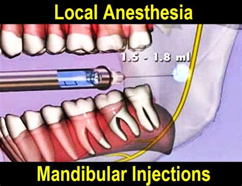 DENTAL ANESTHESIA: Mandibular Injections step by step - Odonto-Tv