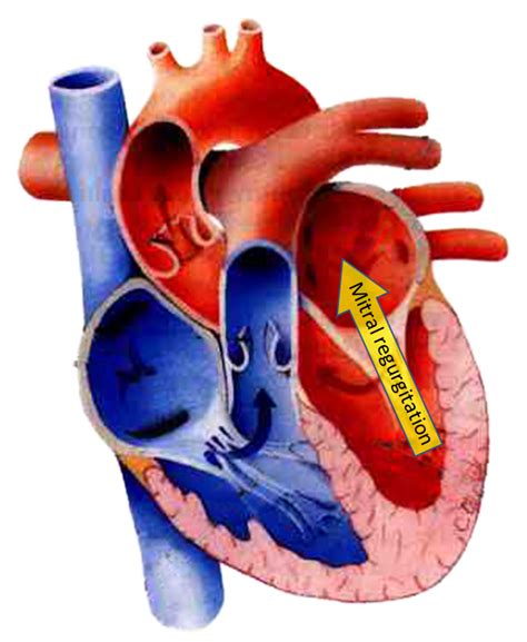 Degenerative Mitral Valve Disease | Gulf Coast Veterinary Cardiology