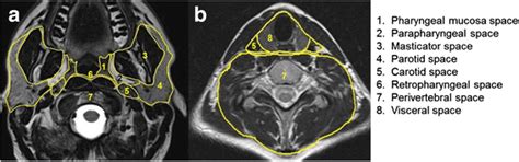 Cross-sectional imaging in cancers of the head and neck: how we review and report | Cancer ...