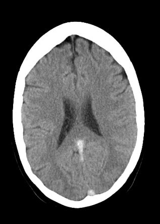 Dural venous sinus thrombosis with cord sign | Radiology Case ...