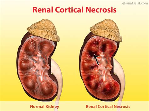 Renal Cortical Necrosis (RCN)|Types | Causes | Risk Factors | Symptoms | Diagnosis | Treatment