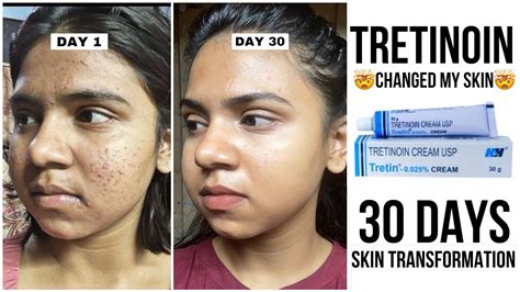 Tretinoin Cream Before And After