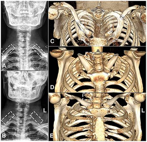 Frontiers | A Novel Approach to First-Rib Resection in Neurogenic Thoracic Outlet Syndrome