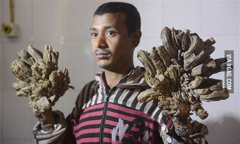 Meet Real Life Groot. The 'Tree Man' will undergo surgery to remove extremely rare ...