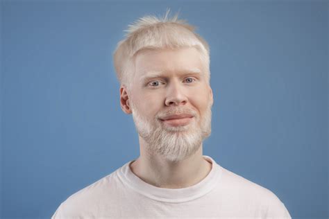 Albinism: Types, Causes, Symptoms and Treatment - AskApollo Blogs