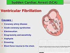 20 Ventricular Fibrillation ideas | cardiac rhythms, heart electrical, cardiac