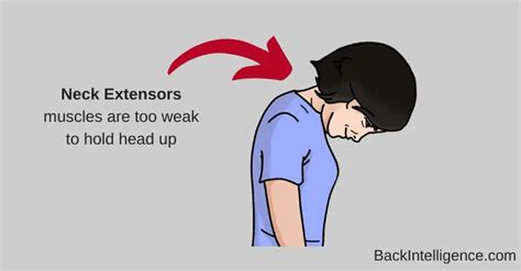 Dropped Head Syndrome Causes & Treatment Options