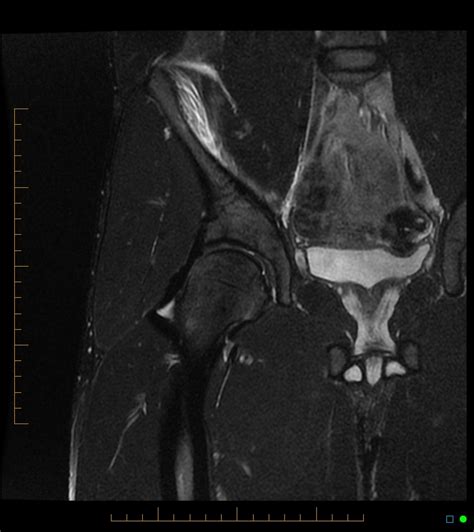 Radiology Cases: Iliopsoas Muscle Tear