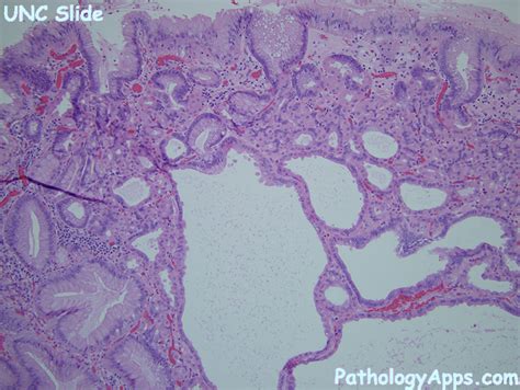 fundic gland polyp pathology