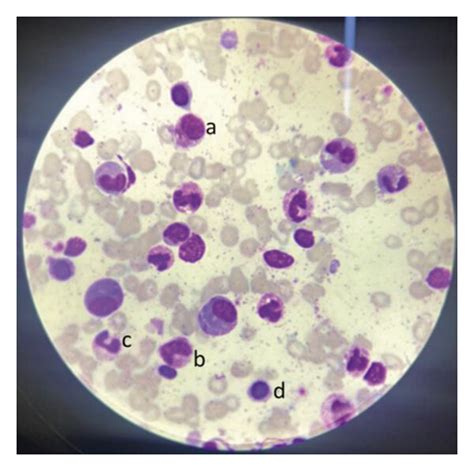 Bone marrow aspirate morphology and FISH result: (a) Bone marrow... | Download Scientific Diagram