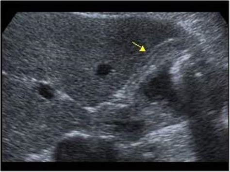 Abdomen and retroperitoneum | 1.2 Gallbladder and bile ducts : Case 1.2 ...