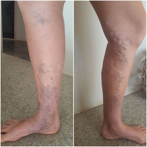 Leg Makeup To Cover Varicose Veins Uk - Mugeek Vidalondon