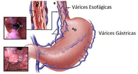 Varices, ¿Qué es?, síntomas, tratamiento - Lascositasdelayaya