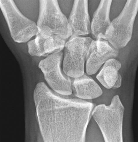 Carpal Bone Fracture