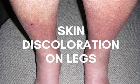 Skin Discoloration On Legs: Causes, Types & Treatments