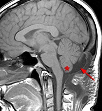 Chiari I Malformation | Radsource