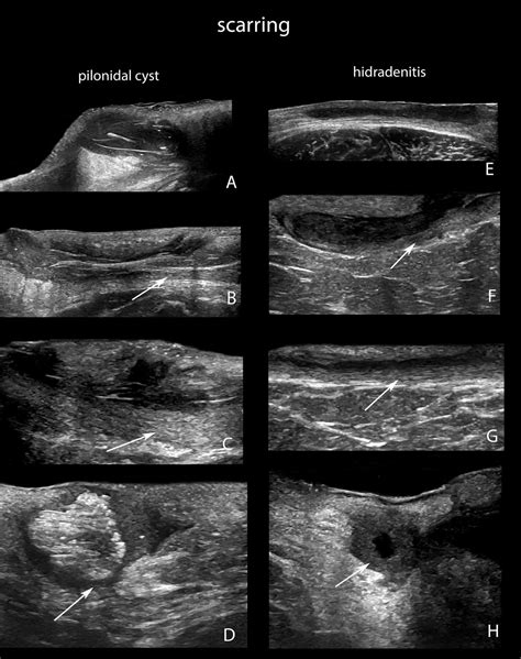 How To Drain A Pilonidal Cyst Yourself Reddit - Best Drain Photos ...