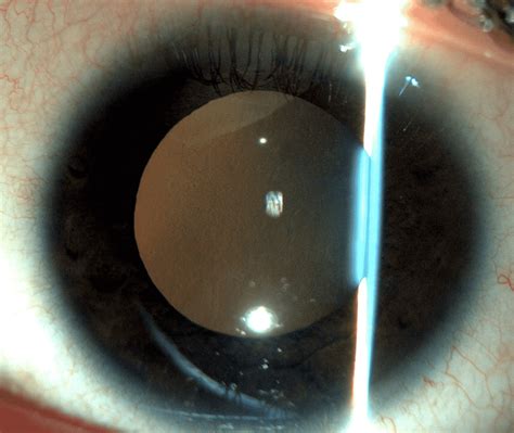 Acute Unilateral Hypopyon Uveitis and Secondary Glaucoma in an Adult With Relapsing Acute ...