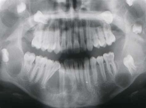 Nevoid Basal Cell Carcinoma Syndrome (NBCCS) | IntechOpen