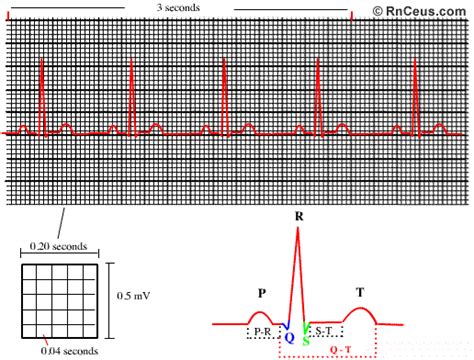 How to Read an EKG Strip