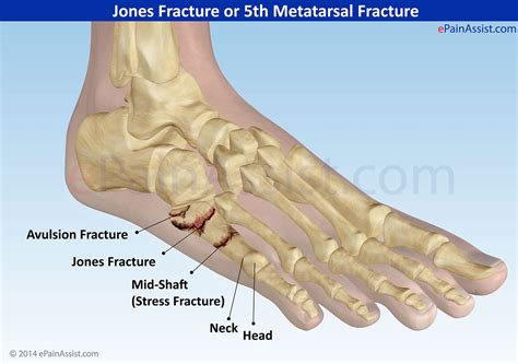 Metatarsal Stress Fracture Foot Symptoms