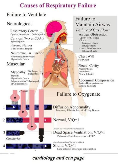 Diagnosis For Acute Respiratory Failure Acute Respiratory Failure, Respiratory Therapy ...