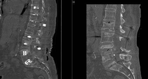 Pedicle Subtraction Osteotomy for Treatment of Sagittal Plane Deformity - cns.org