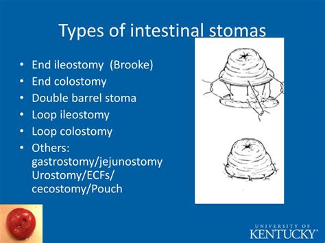 PPT - The Difficult Stoma PowerPoint Presentation - ID:257323