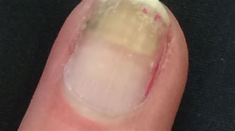 Nail Damage during Treatment for Womb Cancer