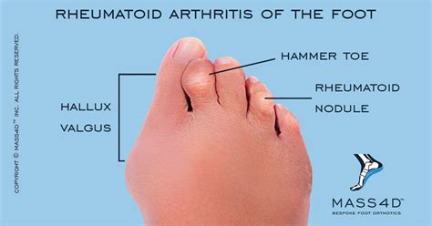 Xray Of Rheumatoid Arthritis In The Feet