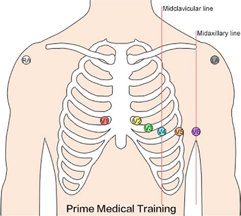 Cardiac Monitor Lead Placement