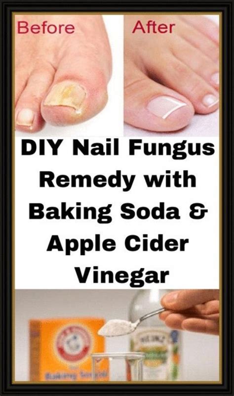 DIY Nail Fungus Remedy with Baking Soda & Apple Cider Vinegar # ...