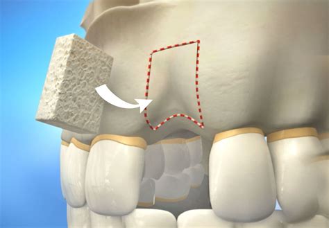 Bone Grafting - Los Algodones, Baja California - Dr. Valenzuela