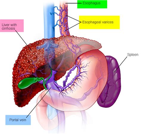 Esophageal Varices - Causes, Symptoms, Grading, Diagnosis, Treatment