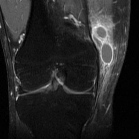 Cyst-like lesions around the knee | pacs