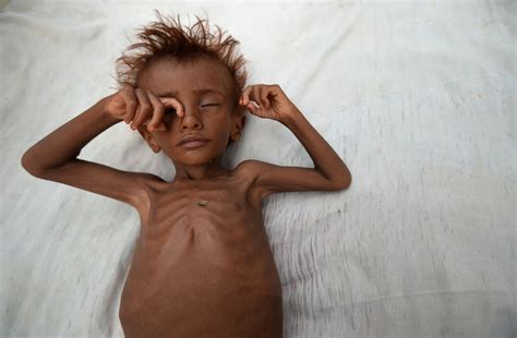 Famine Threatens Yemen Amid Civil War Photos | Image #141 - ABC News