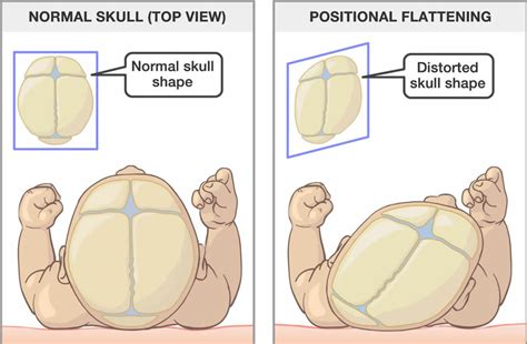 Plagiocephaly causes, symptoms, diagnosis & treatment