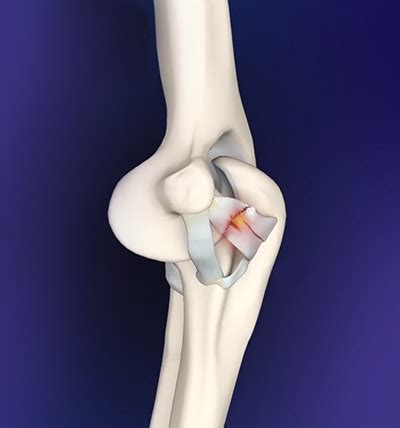 Elbow Ligament Reconstruction Surgery Denver CO | Ligament Injury ...