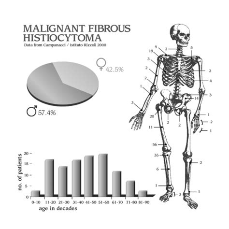 Malignant fibrous histiocytoma | BoneTumor.org