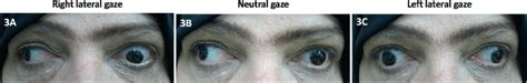 A-C: Wall-eyed bilateral internuclear ophthalmoplegia demonstrated by ...